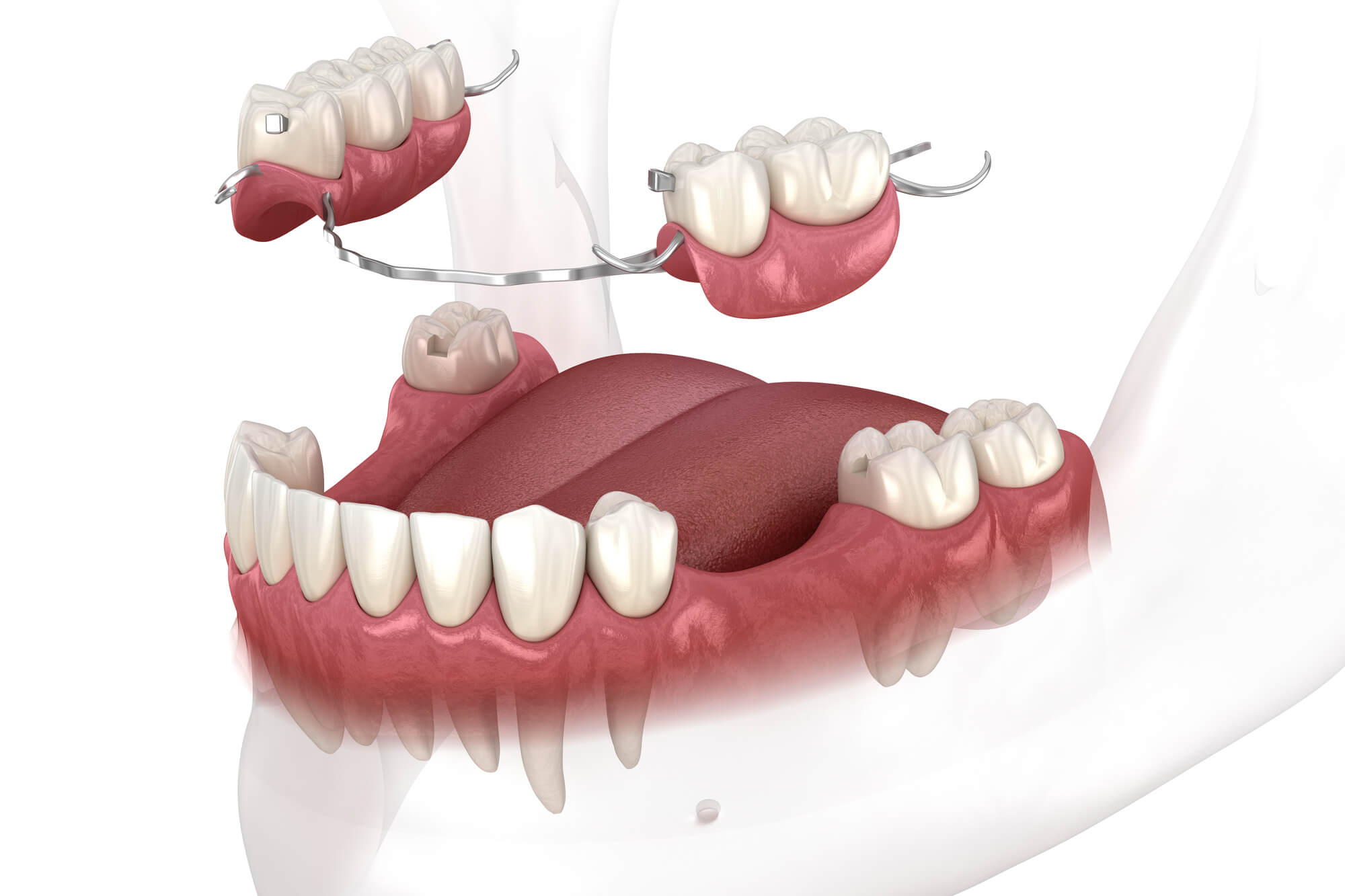 65280429e13c0576a7b961c7_Removable partial denture, mandibular prosthesis